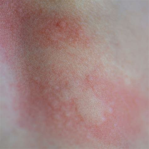 Allergisk reaktion myg